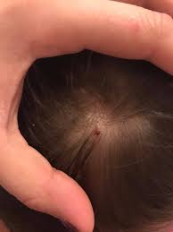 Image result for dry scabs on the head in children