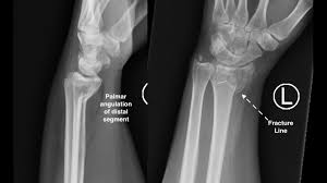 Image result for Wrist XRay