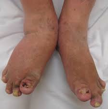 Microbial diseases of the skin are usually transmitted by contact with an infected individual. Psoriatic Arthritis Wikipedia