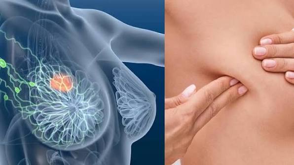 Dấu hiệu cảnh báo sớm ung thư vú và cách phòng ngừa bệnh