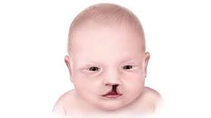 Image result for Cleft Lip