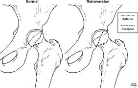 Image result for Femoral Retroversion