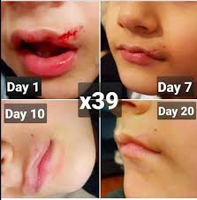 0 Likes 0 Comments Kim Watson Stemcellpatchingprenuer On Instagram Great Healing All Done With Our Healing Improve Skin Appearance Wound Healing