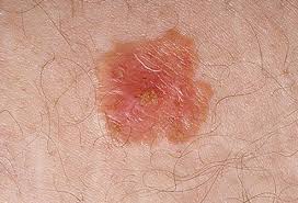 You can get skin cancer anywhere on your skin — from your scalp checking your skin can help you find skin cancer early when it's highly treatable. Skin Cancer Symptoms Types Images