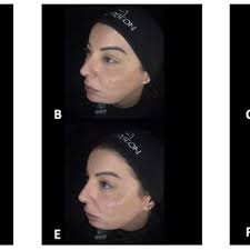 PDF) Aesthetic Rehabilitation of Patients with Central and Peripheral  Facial Palsy with Injectables (BNT-A, HA-Fillers and CaHa)