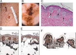 The ultraviolet radiation or uv rays given off by the sun can mutate skin cells and turn them cancerous. Evidence Of Ultraviolet Type Mutations In Xeroderma Pigmentosum Melanomas Pnas