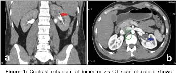 Renal pelvis and ureter cancers affect men more often than women. Leiomyoma Of Renal Pelvis Semantic Scholar