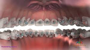 In this article, i want to have a. Hidden Or Lingual Braces Youtube