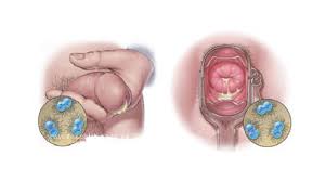Image result for Nongonococcal Urethritis