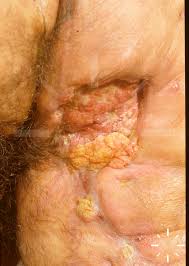 DermaCompass - Hidradenitis suppurativa