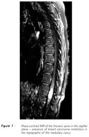The american cancer society provides detailed information on prostate cancer and its treatment. Scielo Brasil Manejo Das Neoplasias Metastaticas Da Coluna Vertebral Uma Atualizacao Manejo Das Neoplasias Metastaticas Da Coluna Vertebral Uma Atualizacao