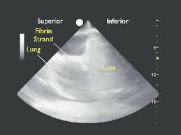 A loculated pleural effusion is the major radiographic hallmark of parapneumonic effusion or empyema (see fig. Ultrasound Of A Loculated Pleural Effusion This Ultrasound Was Taken Download Scientific Diagram