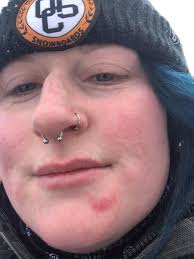 Ate shit in the glades at Waterville yesterday. My face broke my fall.