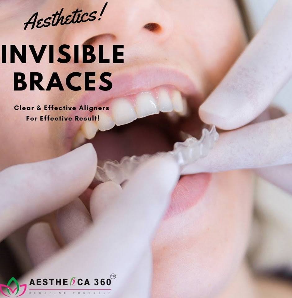 Clear Aligners product image