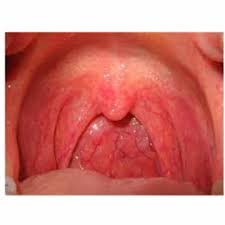 Image result for Pharyngitis