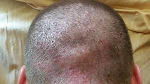 Jangan khawatir karena beberapa cara menghilangkan jerawat di kepala ini bisa kamu jadikan solusi. 10 Cara Menggunakan Lidah Buaya Untuk Rambut Indah Sehat