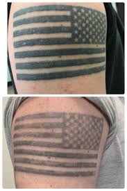 You can get the bald eagle with flag to represent the glorious symbol. 10 Sessions Over Three Years Nanosecond Laser The Tattoo Was Redone Two Years After Application Tattooremoval