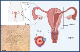 Image result for Friable Cervix