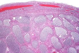 It depends on the individual and the type of testicular cancer. Epididymitis Wikipedia