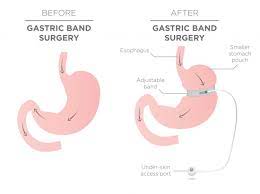 Gastric Banding (Lap-Band Surgery)