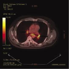 Medically reviewed by jay zatzkin, md; View Of Coal Worker S Pneumoconiosis And Sarcoid Like Reaction Mimicking Lymph Node Metastases In A Patient With Lung Cancer A Case Report The Southwest Respiratory And Critical Care Chronicles