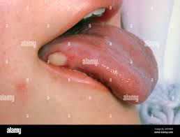 Image result for white cancer on tongue)