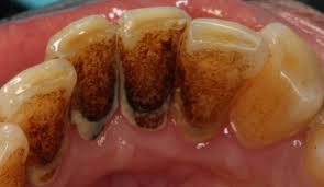 Image result for calculus and stains