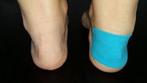Taping The Heels This Is Rocktape Might Help Protect Against Heel Blisters At The Very Least It Can Reduce Abrasive Rubbing A Heel Blisters Feet Blisters