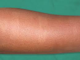 Laser hair removal is a great hyperpigmentation treatment and remains one of the safest treatments for hyperpigmentation and one that should be tried before any other invasive methods are attempted. Jaypeedigital Ebook Reader