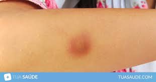 A leucemia é um tipo de câncer maligno, que causa o acúmulo de células doentes na medula óssea, substituindo as saudáveis. Manchas Roxas No Corpo 3 Principais Causas E Como Tratar Tua Saude