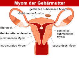 Děloha je symbolem mateřství a všech specifik ženskosti, symbolem plození, symbolem bezpečí pro počaté dítě, symbolem zrození a tvořivosti. Myom Der Gebarmutter Uterusmyom Citypraxen Berlin
