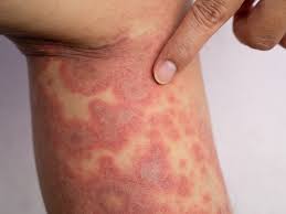 Image result for Atopic eczema atopic dermatitis