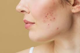How To Get Rid Of Redness From Acne Scars - Beautymed Richmond Hill