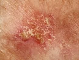 Being armed with information is vital to begin the fight. Can A Skin Injury Turn Into Cancer Yes But What Kind Scary Symptoms