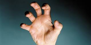 Ditambah juga pada tangan kanan dari jari kelingking hingga bawah siku sering nyeri dan sakit. Penyakit Saraf Kejepit Di Tangan Umumnya Dialami Oleh Pekerja Kantoran Merdeka Com