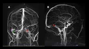 If you have cvst, respond quickly to symptoms like headaches, blurry vision, fainting, losing control of a part of your body, and seizures. Cerebral Venous Sinus Thrombosis In Covid 19 Infection A Case Series And Review Of The Literature Journal Of Stroke And Cerebrovascular Diseases