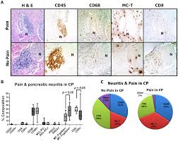Once patients are in this stage, the cancer has spread to other organs, like the. Plos One Perineural Mast Cells Are Specifically Enriched In Pancreatic Neuritis And Neuropathic Pain In Pancreatic Cancer And Chronic Pancreatitis