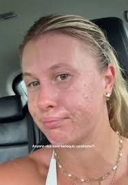 Harlequin Syndrome Babies