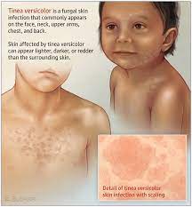 What smell would, for best, probably means is the use of cranberry juice, apple cider vinegar. Tinea Versicolor Know More About It By Dr Radhika A Md Lybrate