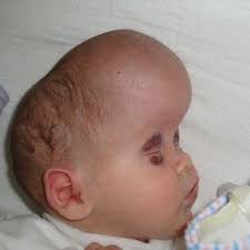 Image result for Vacuum Caput