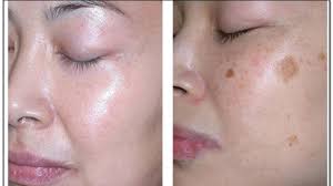 Ada beberapa tips hilangkan jerawat yang dapat anda lakukan. Petua Menghilangkan Jeragat Di Muka Dengan Berkesan Kartel Dakwah