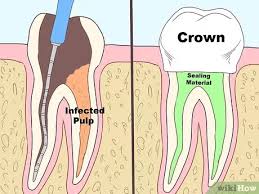 Once areas of enamel are worn away, the bacteria and acid can reach the next layer of your teeth, called dentin. How To Keep A Cavity From Getting Worse With Pictures Wikihow