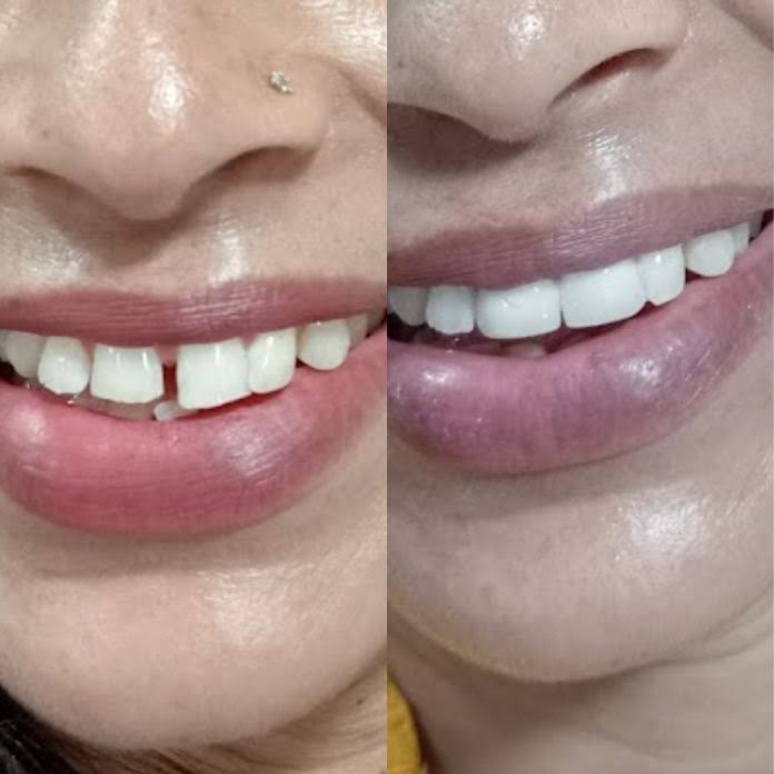 Diestema closure ( midline gap closure)
