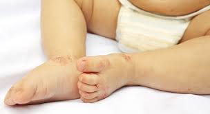 Virusinfektionen Hand Fuss Mund Krankheit Apomio Gesundheitsblog