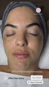 Image result for Diffuse Hyperpigmentation
