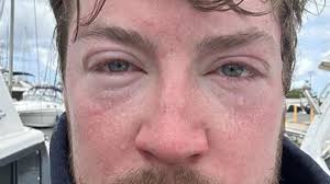 Like a hot iron.' B.C. man's ultra-marathon Hawaiian swim is scuttled by  jellyfish