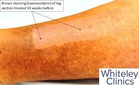 Image result for liver spots on legs