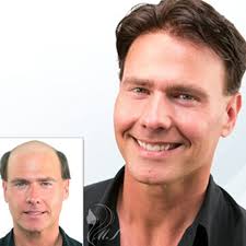 TOP 10 BEST Hair Loss Centers in Indio, CA