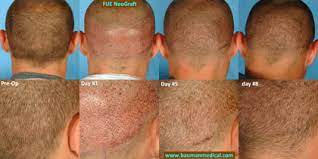 This includes eyelashes, eyebrows and apparently even the scalp. Revolutionary New Hair Loss Procedures Ahb