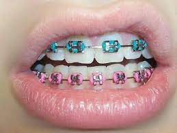 Sent daily from brisbane, australia we stock products under $15. Turquoise And Dark Blue Braces Novocom Top